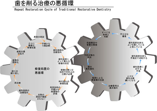 歯を削る治療の悪循環