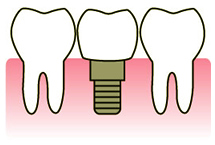 インプラント