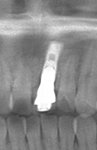 症例２・インプラント植立